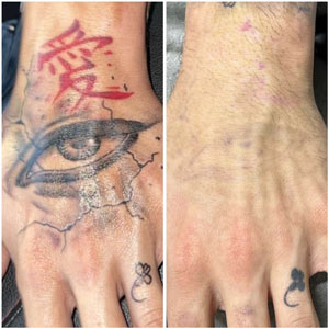 PicoWay Laser Tattoo Removal Before and After Photos of Clients at Laser Duet Med Spa in Dearborn, MI