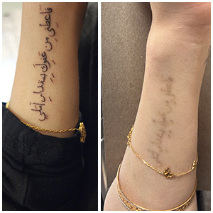 PicoWay Laser Tattoo Removal Before and After Photos of Clients at Laser Duet Med Spa in Dearborn, MI