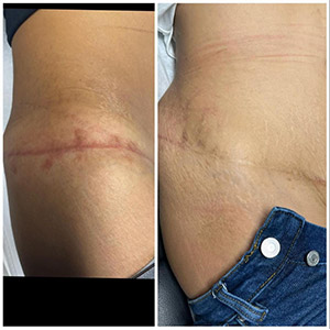 PicoWay Laser Treatment Before and After Photos of Clients at Laser Duet Med Spa in Dearborn, MI