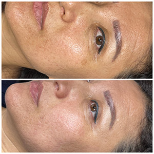 PicoWay Laser Treatment Before and After Photos of Clients at Laser Duet Med Spa in Dearborn, MI