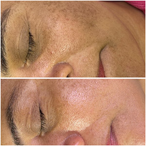 PicoWay Laser Treatment Before and After Photos of Clients at Laser Duet Med Spa in Dearborn, MI