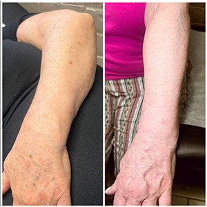 PicoWay Laser Treatment Before and After Photos of Clients at Laser Duet Med Spa in Dearborn, MI