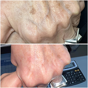 PicoWay Laser Treatment Before and After Photos of Clients at Laser Duet Med Spa in Dearborn, MI