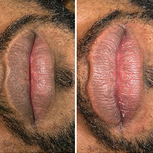 PicoWay Laser Treatment Before and After Photos of Clients at Laser Duet Med Spa in Dearborn, MI