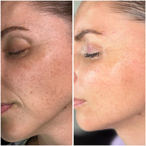 PicoWay Laser Treatment Before and After Photos of Clients at Laser Duet Med Spa in Dearborn, MI