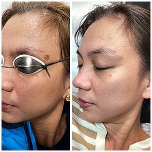PicoWay Laser Treatment Before and After Photos of Clients at Laser Duet Med Spa in Dearborn, MI