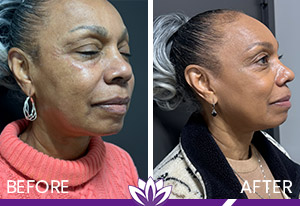 Ultherapy Before and After Photos of Clients at Laser Duet Med Spa in Dearborn, MI