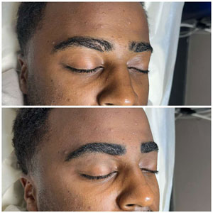 Microblading Before and After Photos of Clients at Laser Duet Med Spa in Dearborn, MI Microblading Before and After Photos of Clients at Laser Duet Med Spa in Dearborn, MI