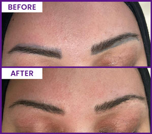 Eyebrow Tattoo Removal Before and After Photos of Clients at Laser Duet Med Spa in Dearborn, MI Eyebrow Tattoo Removal Before and After Photos of Clients at Laser Duet Med Spa in Dearborn, MI