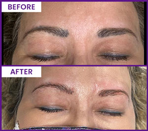 Eyebrow Tattoo Removal Before and After Photos of Clients at Laser Duet Med Spa in Dearborn, MI Eyebrow Tattoo Removal Before and After Photos of Clients at Laser Duet Med Spa in Dearborn, MI