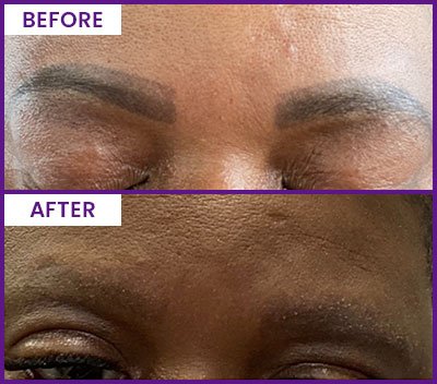 Eyebrow Tattoo Removal Before and After Photos of Clients at Laser Duet Med Spa in Dearborn, MI Eyebrow Tattoo Removal Before and After Photos of Clients at Laser Duet Med Spa in Dearborn, MI