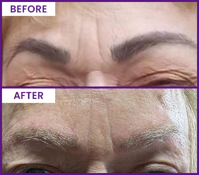 Eyebrow Tattoo Removal Before and After Photos of Clients at Laser Duet Med Spa in Dearborn, MI Eyebrow Tattoo Removal Before and After Photos of Clients at Laser Duet Med Spa in Dearborn, MI