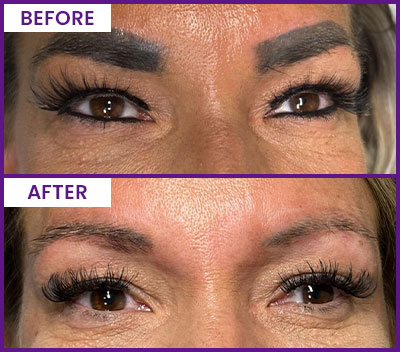 Eyebrow Tattoo Removal Before and After Photos of Clients at Laser Duet Med Spa in Dearborn, MI Eyebrow Tattoo Removal Before and After Photos of Clients at Laser Duet Med Spa in Dearborn, MI