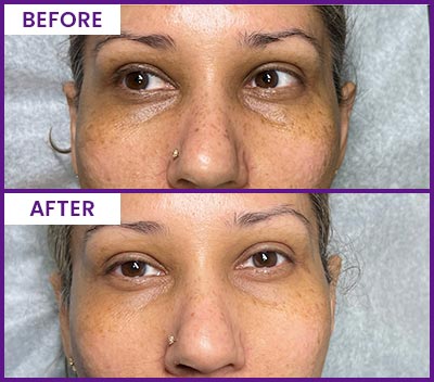 Eyebrow Tattoo Removal Before and After Photos of Clients at Laser Duet Med Spa in Dearborn, MI Eyebrow Tattoo Removal Before and After Photos of Clients at Laser Duet Med Spa in Dearborn, MI