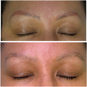 Eyebrow Tattoo Removal Before and After Photos of Clients at Laser Duet Med Spa in Dearborn, MI Eyebrow Tattoo Removal Before and After Photos of Clients at Laser Duet Med Spa in Dearborn, MI