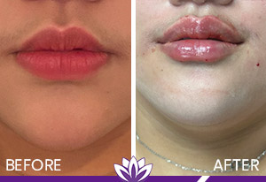 Lip Filler Before and After Photos of Clients at Laser Duet Med Spa in Dearborn, MI Lip Filler Before and After Photos of Clients at Laser Duet Med Spa in Dearborn, MI