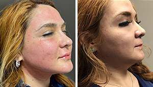 Morpheus8 Before and After Photos of Clients at Laser Duet Med Spa in Dearborn, MI Morpheus8 Before and After Photos of Clients at Laser Duet Med Spa in Dearborn, MI