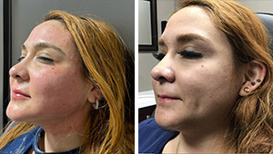 Morpheus8 Before and After Photos of Clients at Laser Duet Med Spa in Dearborn, MI Morpheus8 Before and After Photos of Clients at Laser Duet Med Spa in Dearborn, MI