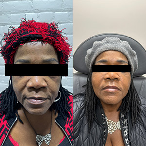 PDO Thread and PRP Treatment Before and After Photos of Clients at Laser Duet Med Spa in Dearborn, MI PDO Thread and PRP Treatment Before and After Photos of Clients at Laser Duet Med Spa in Dearborn, MI