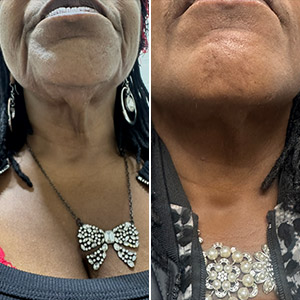 PDO Thread and PRP Treatment Before and After Photos of Clients at Laser Duet Med Spa in Dearborn, MI PDO Thread and PRP Treatment Before and After Photos of Clients at Laser Duet Med Spa in Dearborn, MI