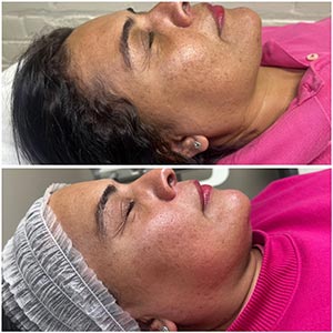 PicoWay Laser Treatment Before and After Photos of Clients at Laser Duet Med Spa in Dearborn, MI PicoWay Laser Treatment Before and After Photos of Clients at Laser Duet Med Spa in Dearborn, MI
