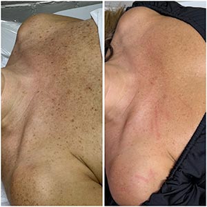 PicoWay Laser Treatment Before and After Photos of Clients at Laser Duet Med Spa in Dearborn, MI PicoWay Laser Treatment Before and After Photos of Clients at Laser Duet Med Spa in Dearborn, MI