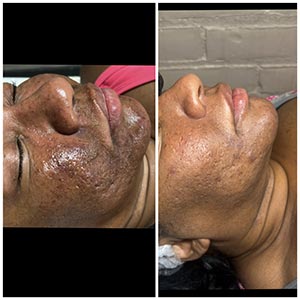 PicoWay Laser Treatment Before and After Photos of Clients at Laser Duet Med Spa in Dearborn, MI PicoWay Laser Treatment Before and After Photos of Clients at Laser Duet Med Spa in Dearborn, MI