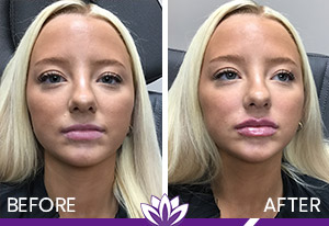 Lip Filler Before and After Photos of Clients at Laser Duet Med Spa in Dearborn, MI Lip Filler Before and After Photos of Clients at Laser Duet Med Spa in Dearborn, MI