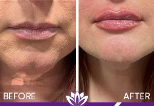 Lip Filler Before and After Photos of Clients at Laser Duet Med Spa in Dearborn, MI