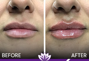 Lip Fillers Treatment in Dearborn, MI