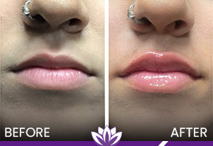 Lip Fillers Treatment in Dearborn, MI