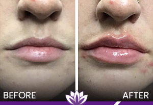 Lip Fillers Treatment in Dearborn, MI