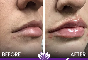 Lip Fillers Treatment in Dearborn, MI