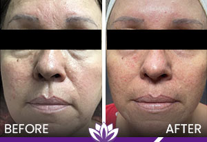 Ultherapy and PicoWay Before and After Photos of Clients at Laser Duet Med Spa in Dearborn, MI
