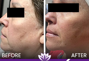 Ultherapy and PicoWay Before and After Photos of Clients at Laser Duet Med Spa in Dearborn, MI