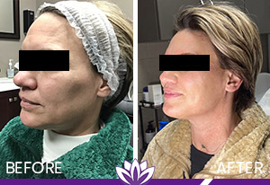 Ultherapy and PicoWay Before and After Photos of Clients at Laser Duet Med Spa in Dearborn, MI
