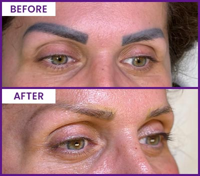 Eyebrow Tattoo Removal Before and After Photos of Clients at Laser Duet Med Spa in Dearborn, MI Eyebrow Tattoo Removal Before and After Photos of Clients at Laser Duet Med Spa in Dearborn, MI