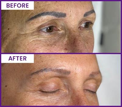 Eyebrow Tattoo Removal Before and After Photos of Clients at Laser Duet Med Spa in Dearborn, MI Eyebrow Tattoo Removal Before and After Photos of Clients at Laser Duet Med Spa in Dearborn, MI