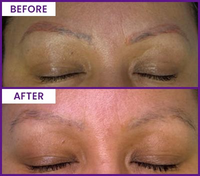 Eyebrow Tattoo Removal Before and After Photos of Clients at Laser Duet Med Spa in Dearborn, MI Eyebrow Tattoo Removal Before and After Photos of Clients at Laser Duet Med Spa in Dearborn, MI
