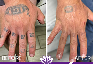 PicoWay Laser Tattoo Removal Before and After Photos of Clients at Laser Duet Med Spa in Dearborn, MI