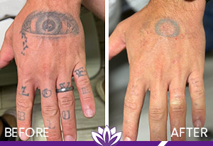 PicoWay Laser Tattoo Removal Before and After Photos of Clients at Laser Duet Med Spa in Dearborn, MI