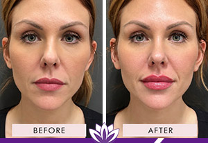 Lip Filler Before and After Photos of Clients at Laser Duet Med Spa in Dearborn, MI