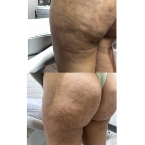 Cellulite Reduction Before and After Photos of Clients at Laser Duet Med Spa in Dearborn, MI Cellulite Reduction Before and After Photos of Clients at Laser Duet Med Spa in Dearborn, MI