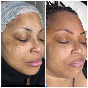 PicoWay® Resolve Facial Rejuvenation Treatment in Dearborn, MI